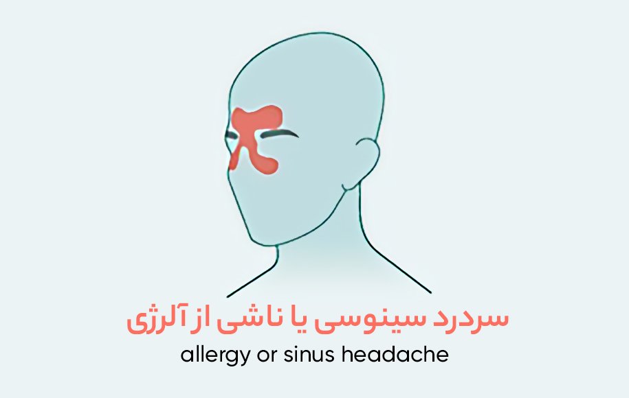 سردرد سینوسی
